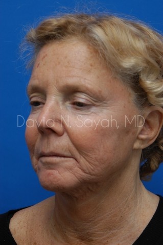 Neck Lift Before and After | Sayah Institute