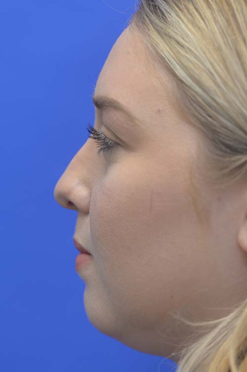 Neck Lipo Before and After | Sayah Institute