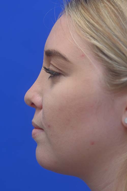 Neck Lipo Before and After | Sayah Institute
