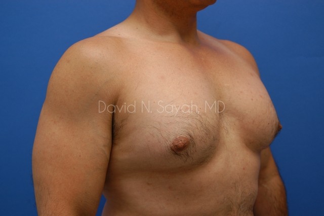 Nipple Revision Before and After | Sayah Institute