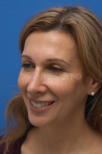 Rhinoplasty Before and After | Sayah Institute