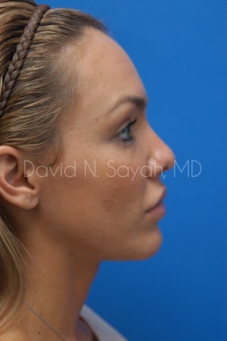 Rhinoplasty Before and After | Sayah Institute