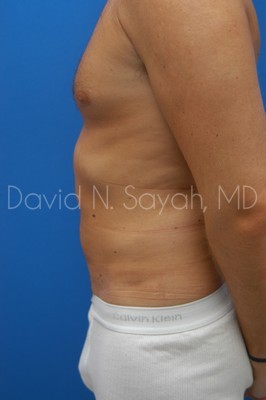 Scar Revision Body Before and After | Sayah Institute