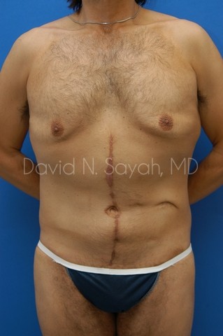 Scar Revision Body Before and After | Sayah Institute