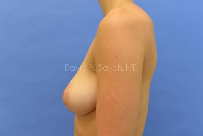 Scar Revision Breast Before and After | Sayah Institute