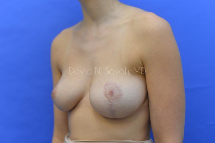 Scar Revision Breast Before and After | Sayah Institute