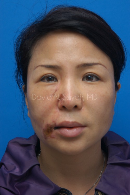 Scar Revision Face Before and After | Sayah Institute