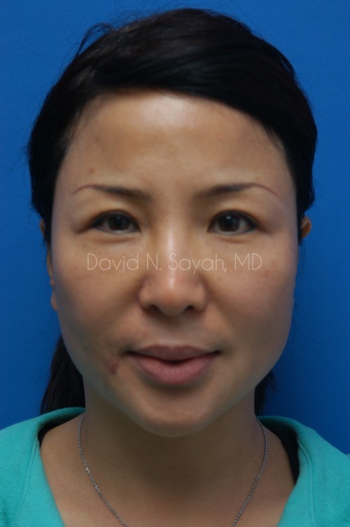 Scar Revision Face Before and After | Sayah Institute