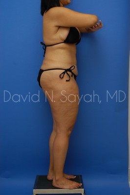 Thigh Lift Before and After | Sayah Institute