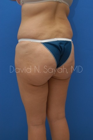 Thigh Lift Before and After | Sayah Institute