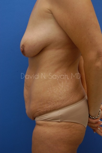 Tummy Tuck Before and After | Sayah Institute