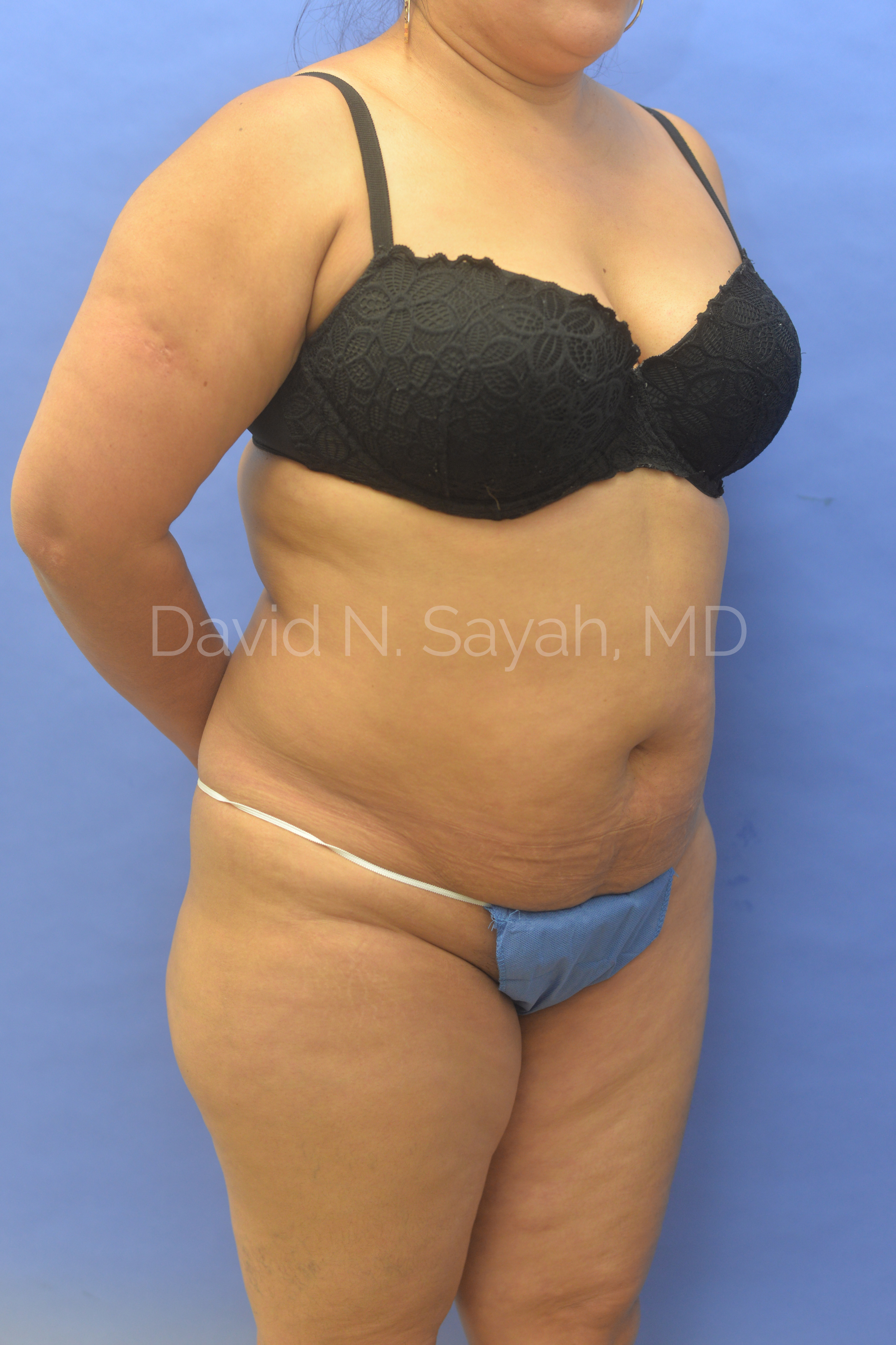 Tummy Tuck Before and After | Sayah Institute