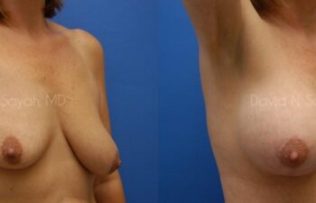 Breast Augmentation And Mastopexy Before and After | Sayah Institute