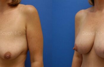 Breast Augmentation And Mastopexy Before and After | Sayah Institute