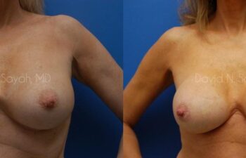 Breast Implant Revision Before and After | Sayah Institute