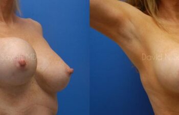 Breast Implant Revision Before and After | Sayah Institute