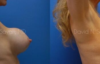 Breast Implant Revision Before and After | Sayah Institute