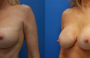 Breast Implant Revision Before and After | Sayah Institute