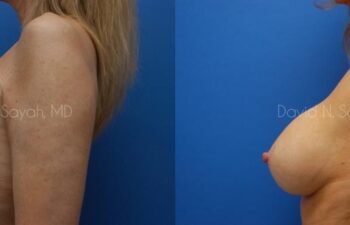 Breast Implant Revision Before and After | Sayah Institute