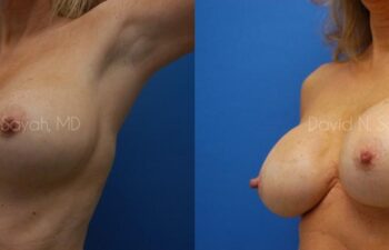 Breast Implant Revision Before and After | Sayah Institute