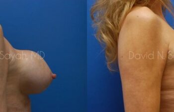 Breast Implant Revision Before and After | Sayah Institute