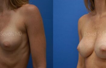 Breast Implant Revision Before and After | Sayah Institute