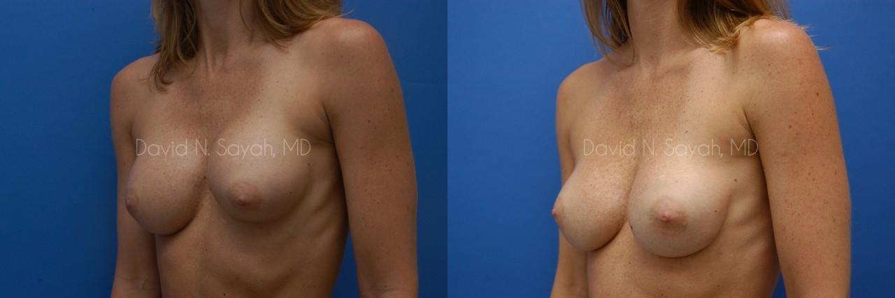 Breast Implant Revision Before and After | Sayah Institute