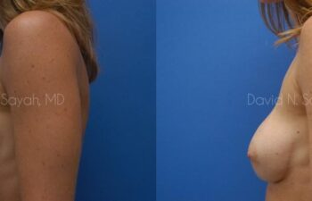 Breast Implant Revision Before and After | Sayah Institute