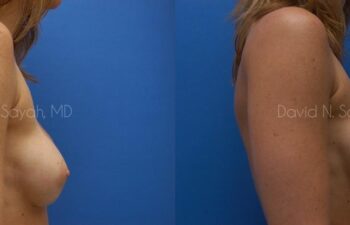 Breast Implant Revision Before and After | Sayah Institute