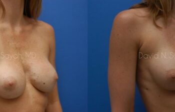 Breast Implant Revision Before and After | Sayah Institute