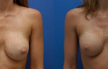 Breast Implant Revision Before and After | Sayah Institute