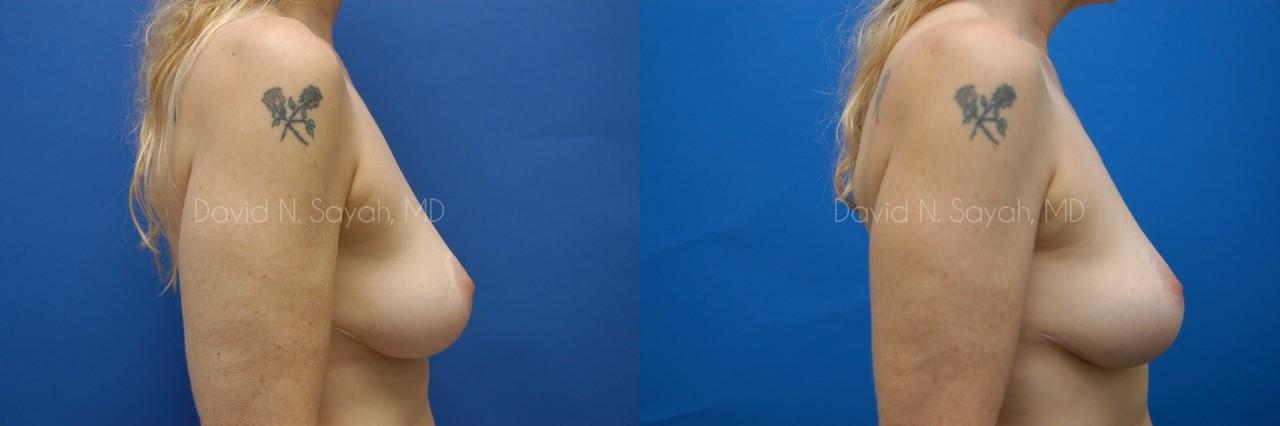 Breast Augmentation And Mastopexy Before and After | Sayah Institute