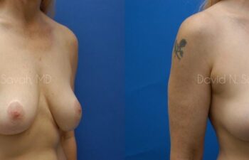 Breast Augmentation And Mastopexy Before and After | Sayah Institute