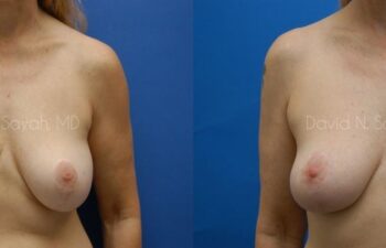 Breast Augmentation And Mastopexy Before and After | Sayah Institute