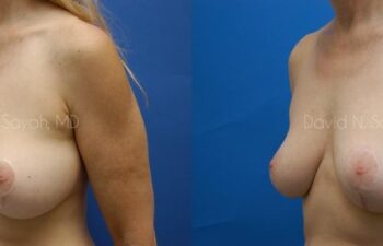 Breast Augmentation And Mastopexy Before and After | Sayah Institute