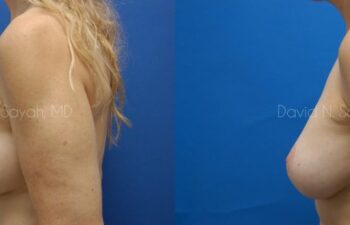 Breast Augmentation And Mastopexy Before and After | Sayah Institute