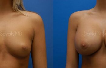Breast Augmentation Before and After | Sayah Institute