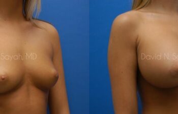Breast Augmentation Before and After | Sayah Institute