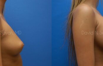 Breast Augmentation Before and After | Sayah Institute