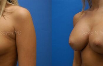 Breast Augmentation Before and After | Sayah Institute