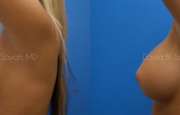 Breast Augmentation Before and After | Sayah Institute