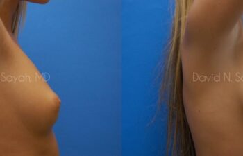 Breast Augmentation Before and After | Sayah Institute