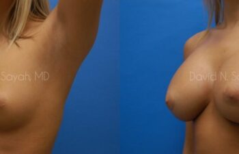 Breast Augmentation Before and After | Sayah Institute