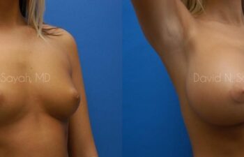 Breast Augmentation Before and After | Sayah Institute
