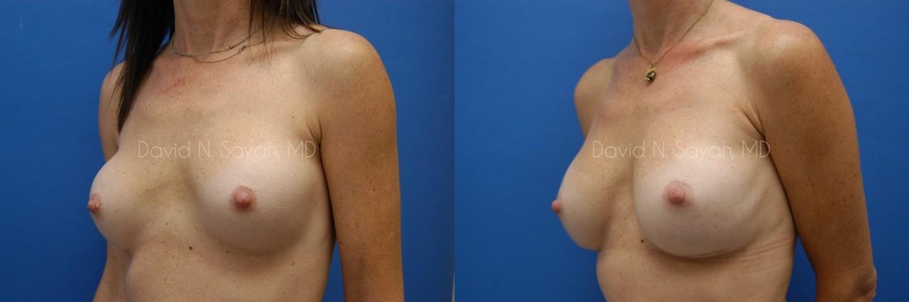 Breast Implant Exchange Before and After | Sayah Institute