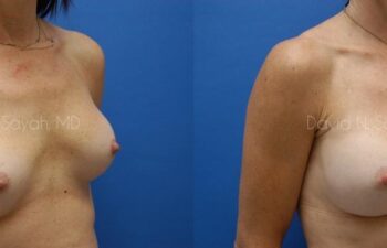 Breast Implant Exchange Before and After | Sayah Institute