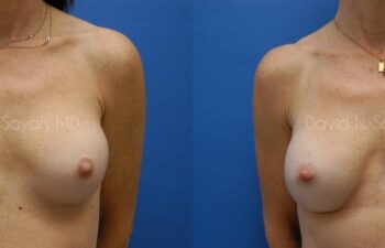 Breast Implant Exchange Before and After | Sayah Institute