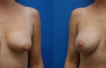 Breast Implant Revision Before and After | Sayah Institute