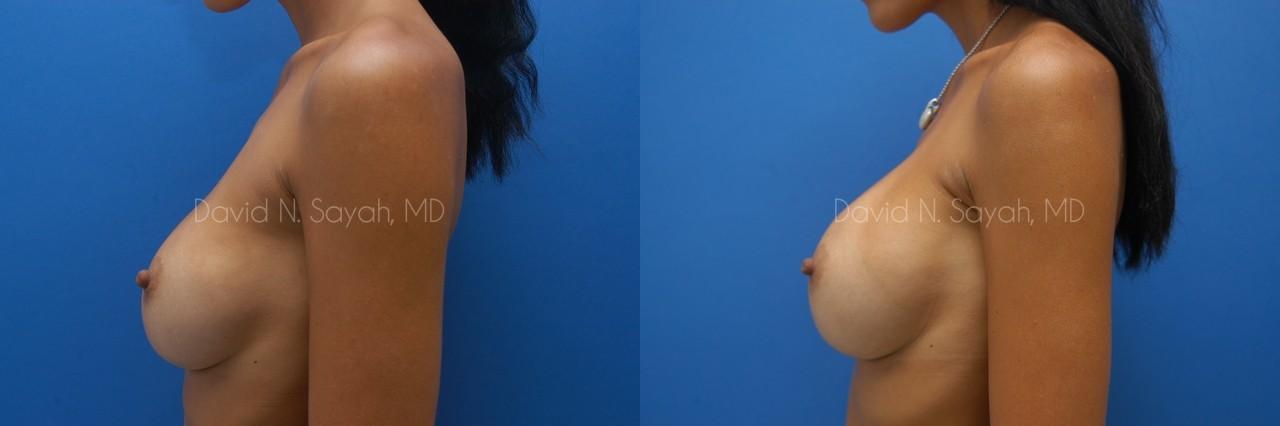 Breast Implant Revision Before and After | Sayah Institute