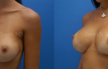 Breast Implant Revision Before and After | Sayah Institute